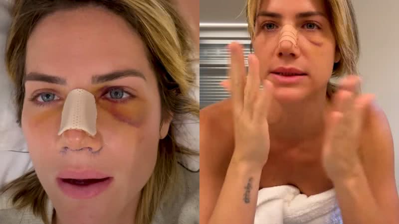 Giovanna Ewbank Fala Sobre Cirurgia No Nariz “me Faltava O Ar Real” 