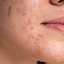 Entenda mais sobre a acne em diferentes fases da vida