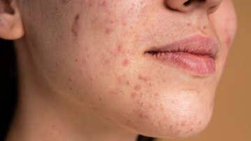 Entenda mais sobre a acne em diferentes fases da vida - FreePik