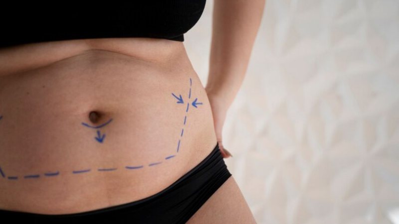 Lipo LAD é a cirurgia plástica mais realizada no Brasil - Freepik