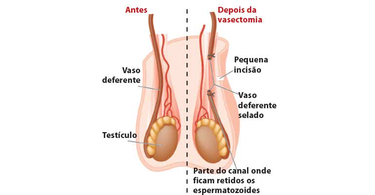 “Para onde vão os espermatozoides  depois que o homem  faz vasectomia?” - Shutterstock