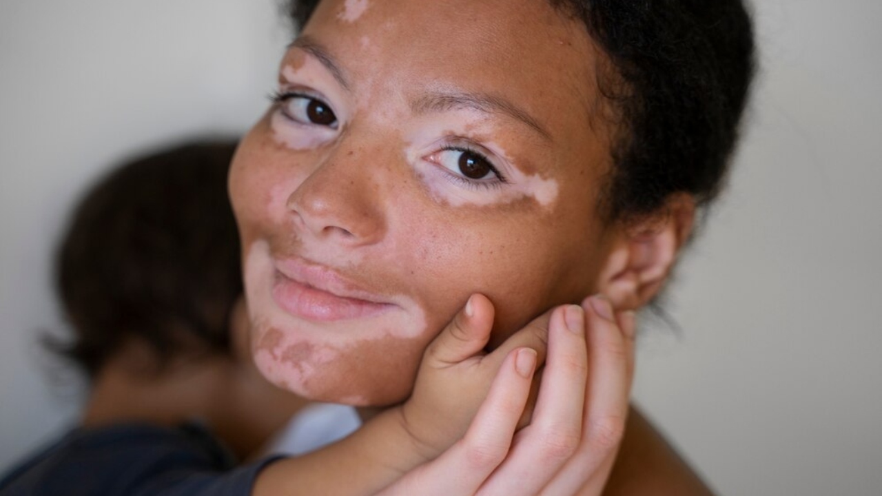 o que é vitiligo tem cura entenda a doença