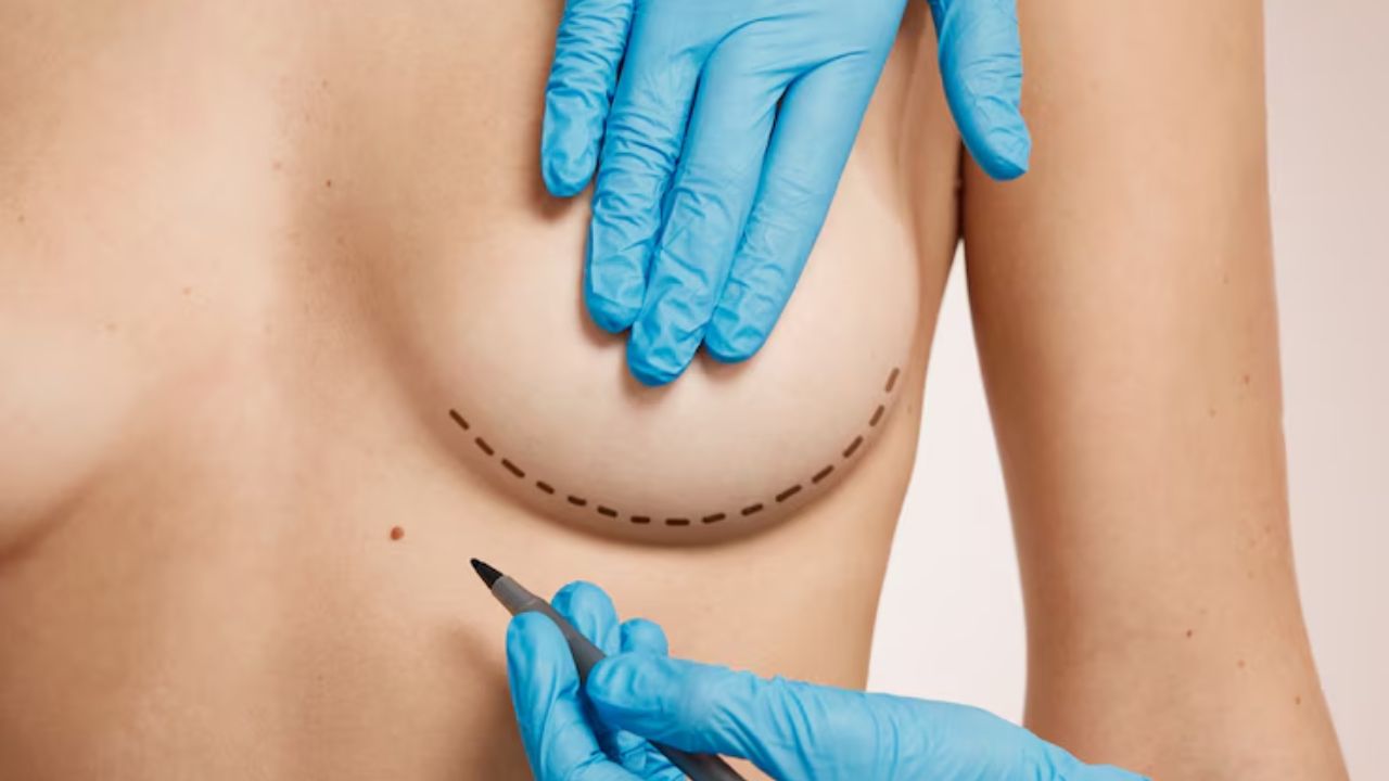 mamoplastia redutora