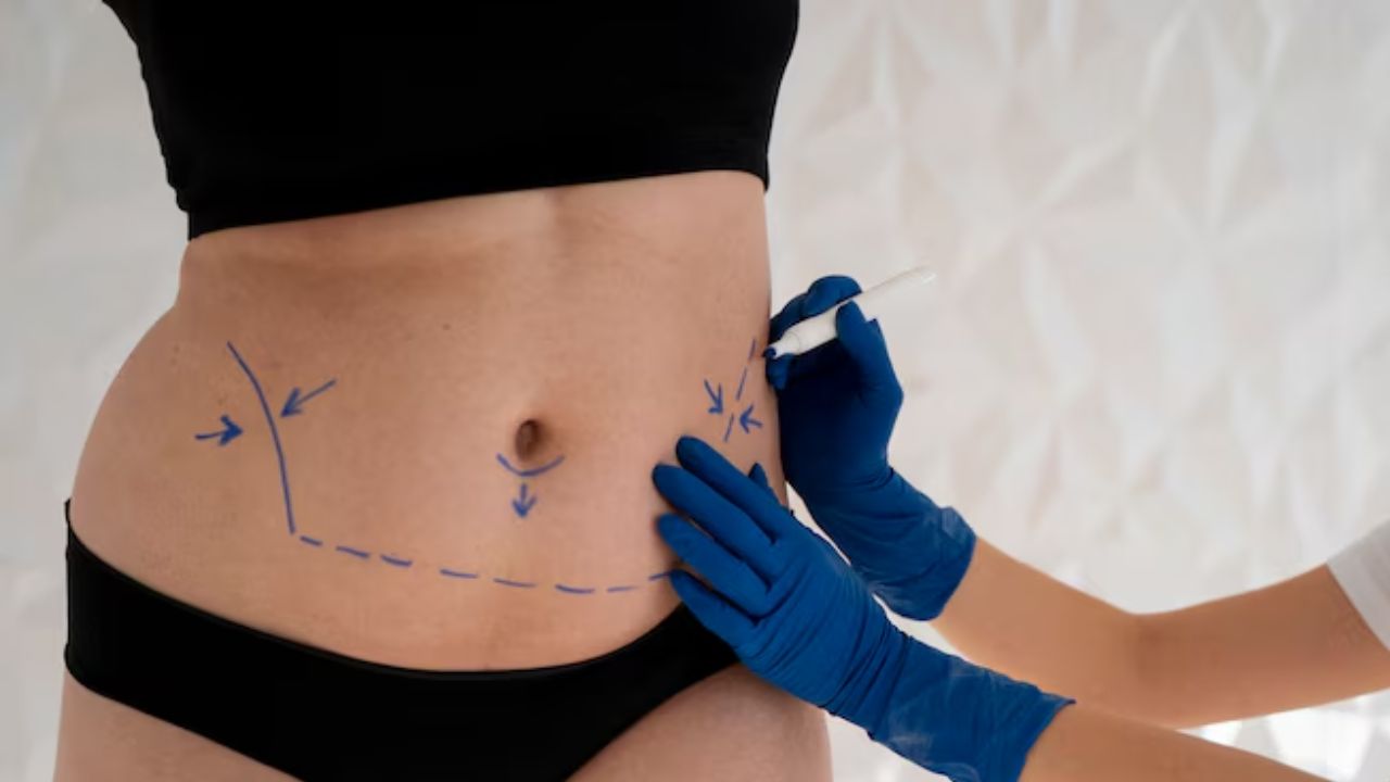 abdominoplastia reversa