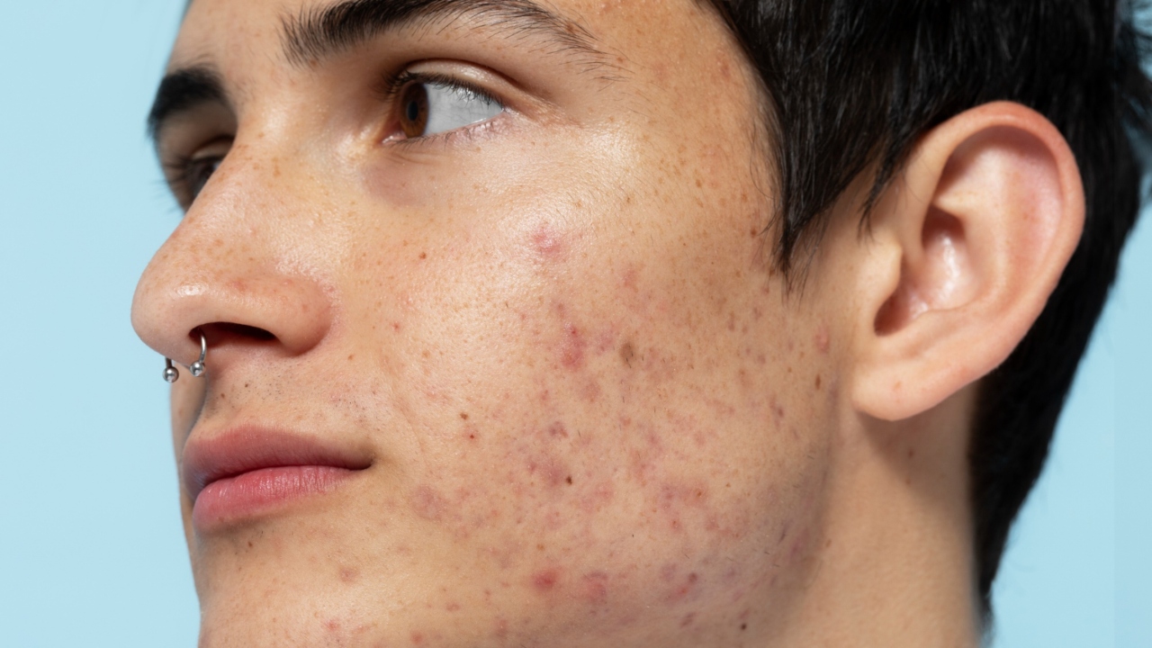 Acne em diferentes fases da vida: meninos são mais afetados por espinhas na adolescência