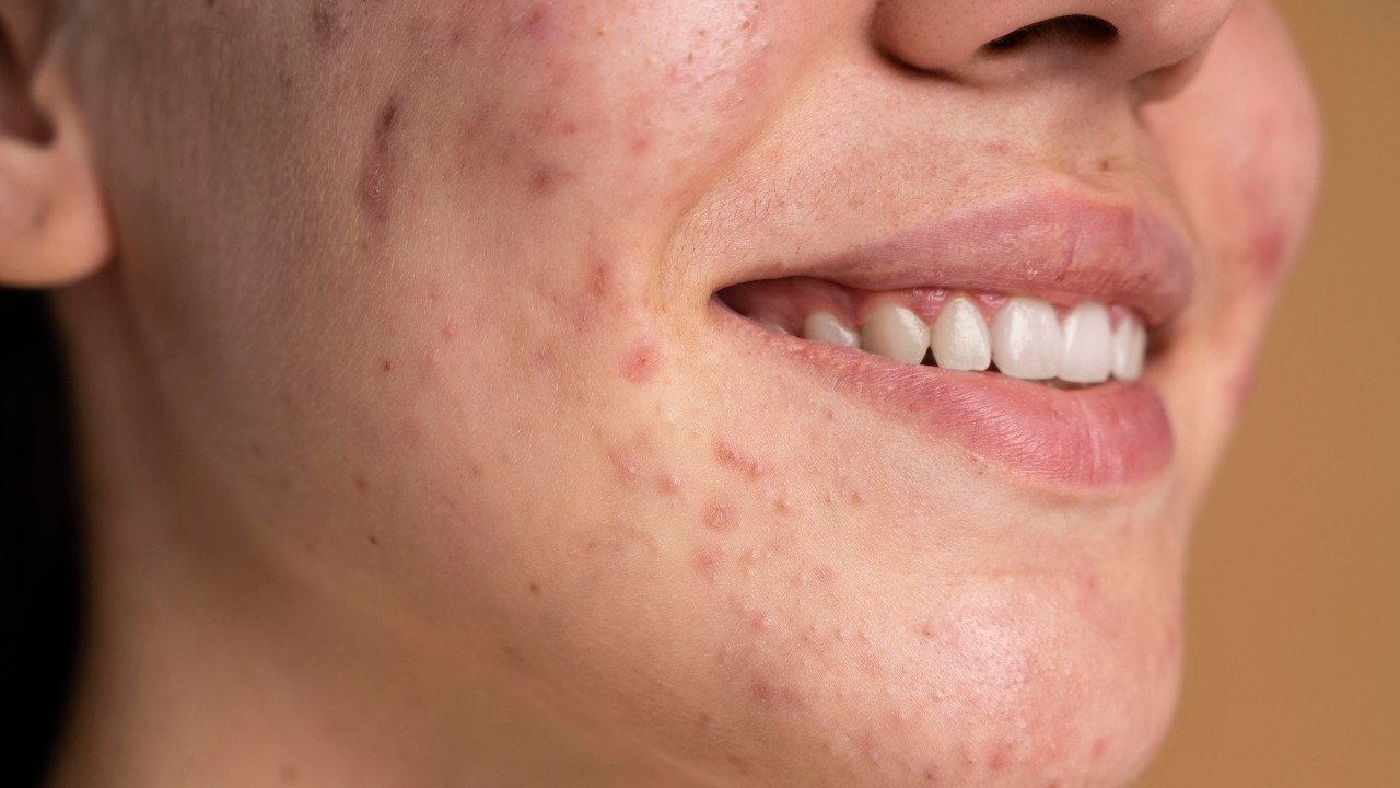 Quais são os sintomas da celulite facial infecciosa?