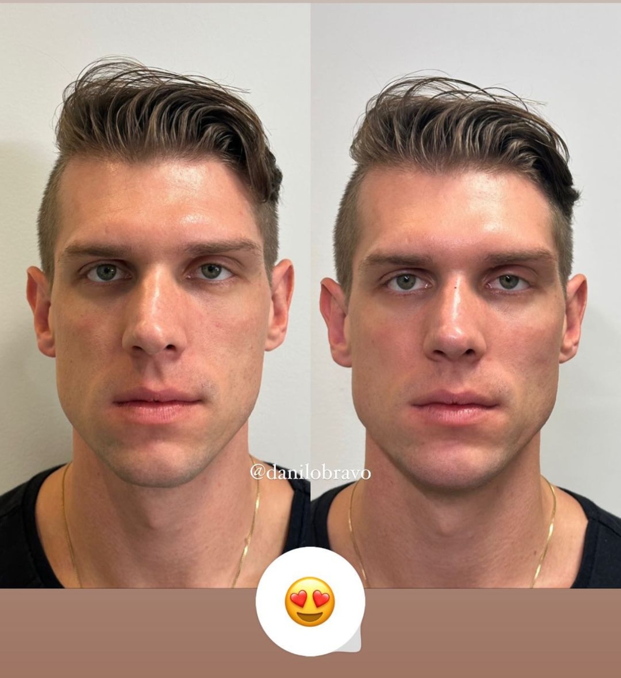 Cristian harmonização facial