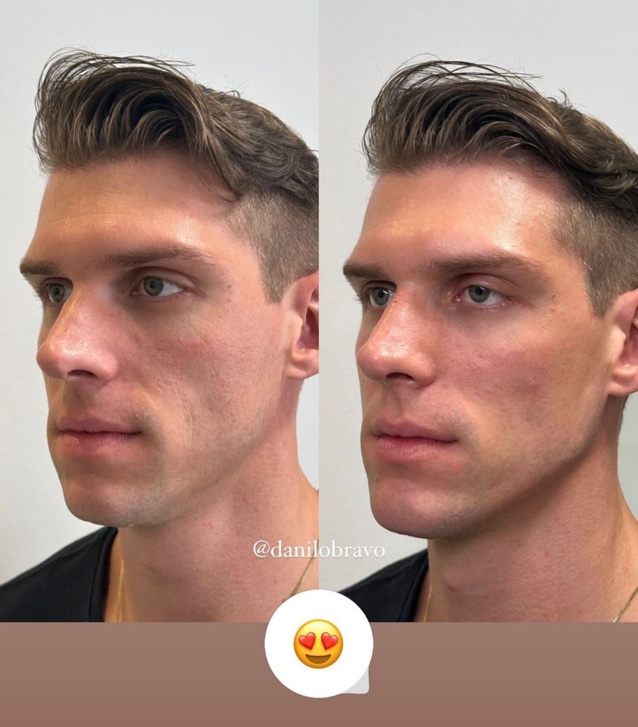 Cristian harmonização facial