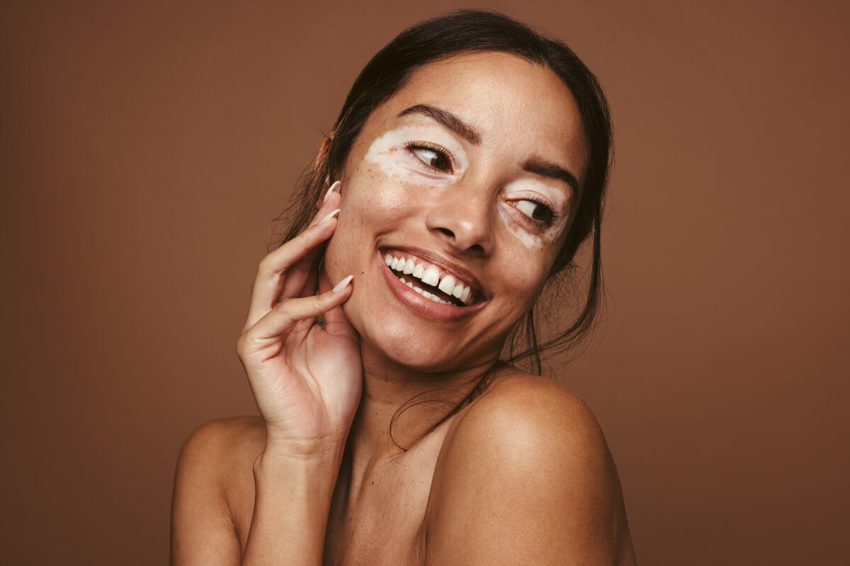 Preconceitos e estigmas afetam o convívio social de pessoas com vitiligo (Imagem: Shutterstock)