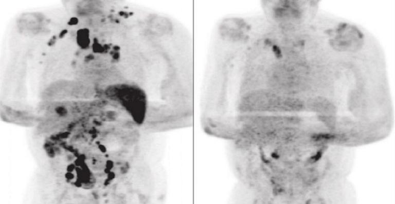 Divulgação/ British Journal of Haematology