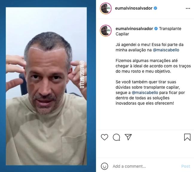 Malvino Salvador aposta em procedimento estético 