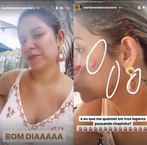 Marília Mendonça mostra queimaduras por chapinha, no rosto