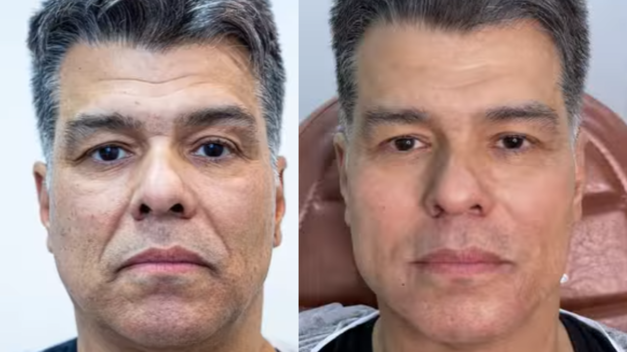 Maurício Mattar harmonização facial