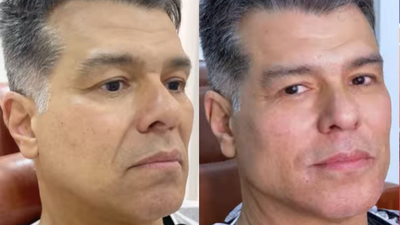 Maurício Mattar harmonização facial