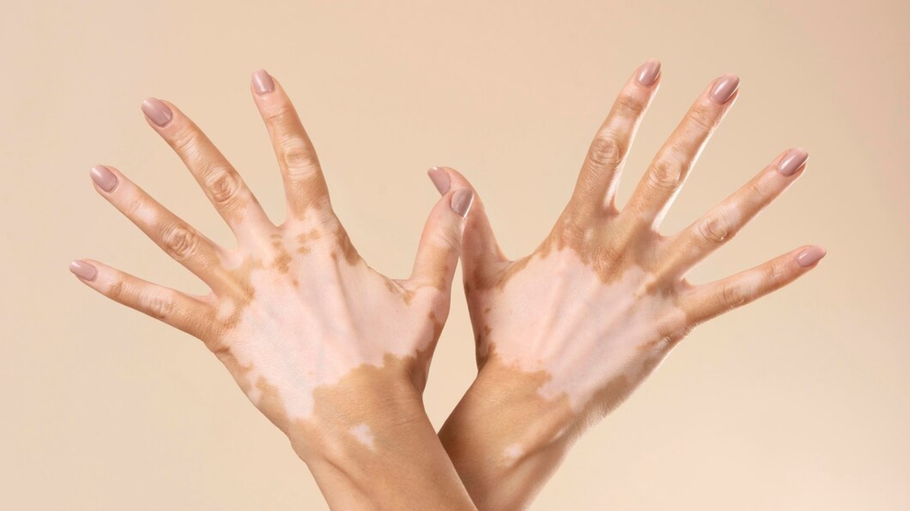 o que é vitiligo tem cura manchas brancas