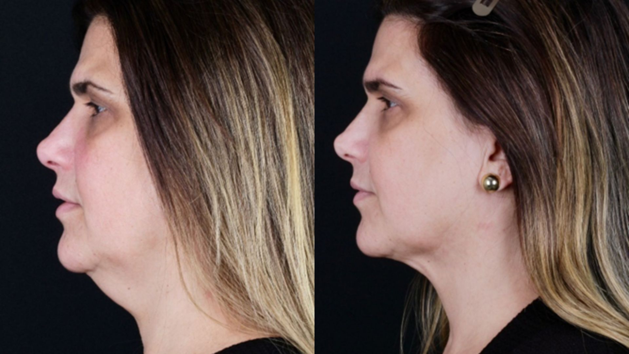 lipo de papada