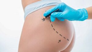 harmonização de bumbum