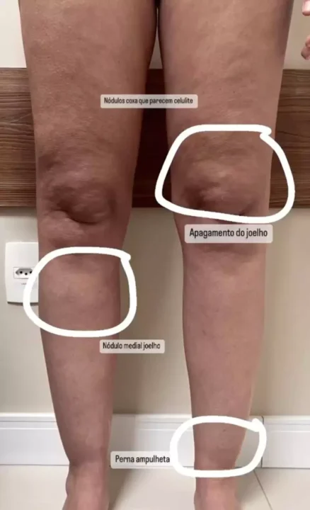 A cirurgiã vascular Thais Torres mostra sinais do lipedema em vídeo no TikTok. Imagem: Reprodução