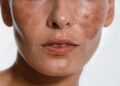 melasma