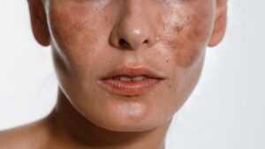 melasma