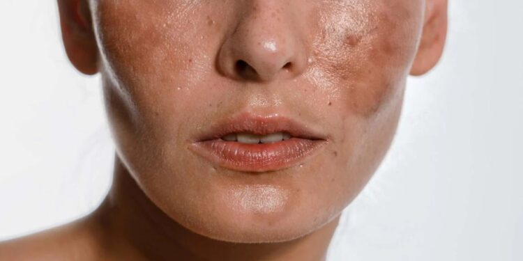 melasma