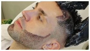 transplante de barba