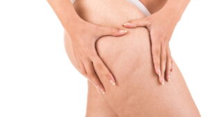 Cansada da celulite? Transforme sua pele com essas dicas