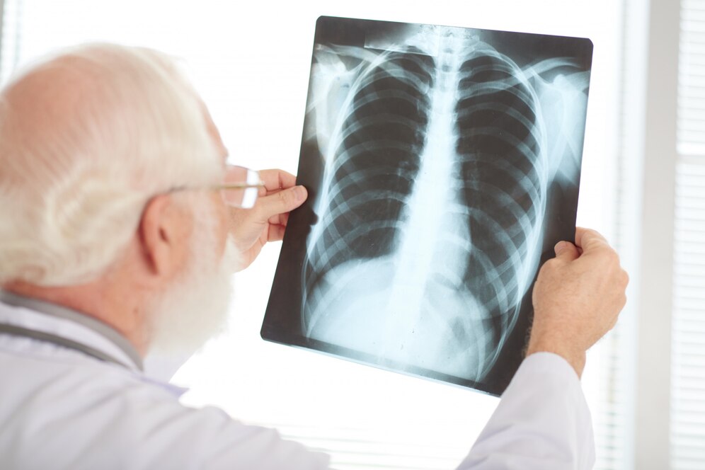 pneumonia em idosos: por que ela pode ser grave?