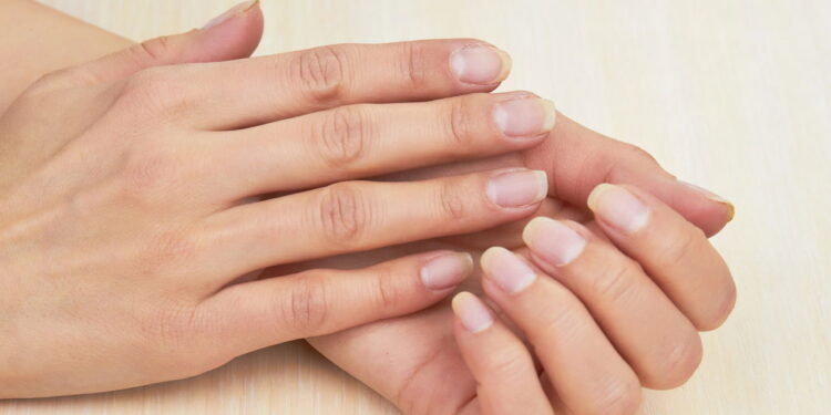 O que significam manchas brancas nas unhas?