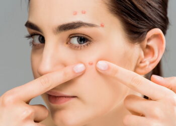 Roacutan para acne severas, como funciona e quais são os riscos