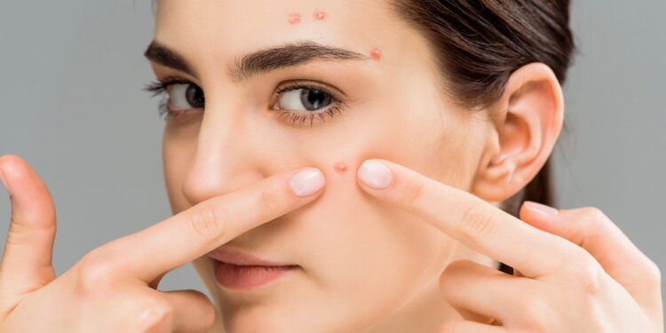 Roacutan para acne severas, como funciona e quais são os riscos