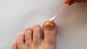 Fungos nas unhas dos pés? Conheça soluções caseiras!