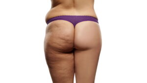 Cansada da celulite? Transforme sua pele com essas dicas