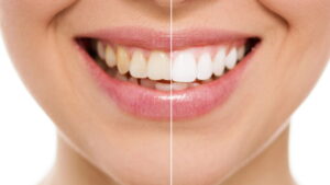 Sorriso radiante, dicas naturais para dentes mais brancos