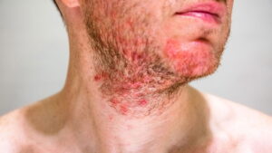 Como tratar e prevenir a foliculite, dicas e remédios naturais