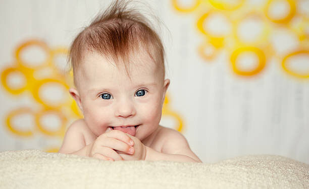 cheerful little baby girl with Downs Syndrome