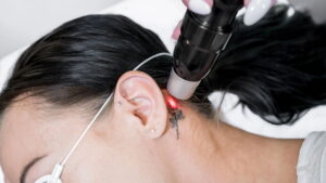 Tatuagem indesejada? Tudo sobre os métodos de remoção