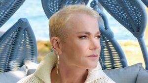 alopecia androgenética