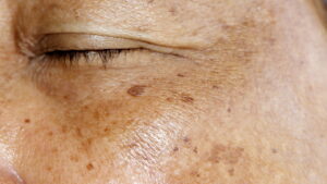 Melhores ingredientes naturais para reduzir manchas na pele de forma eficaz