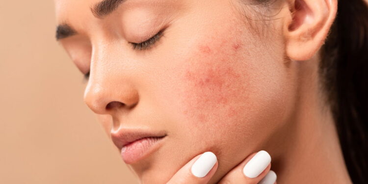 Como cuidar da pele sensível e evitar irritações com uma rotina simples
