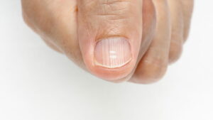 Tratamento eficaz para unhas fracas e esbranquiçadas