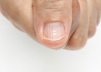 Tratamento eficaz para unhas fracas e esbranquiçadas