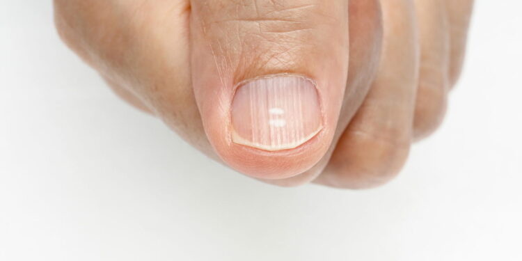 Tratamento eficaz para unhas fracas e esbranquiçadas