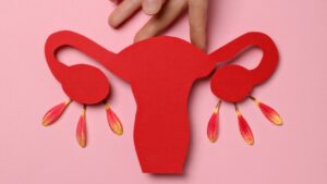 endometriose