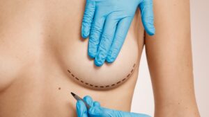 cirurgia das mamas