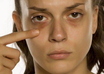 Mulher com olheira - Por que você tem olheiras mesmo dormindo bem?