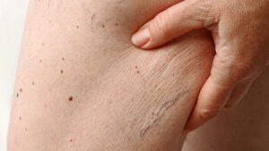Pele seca? Aprenda a hidratar com ingredientes naturais