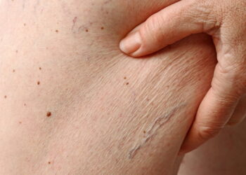 Pele seca? Aprenda a hidratar com ingredientes naturais