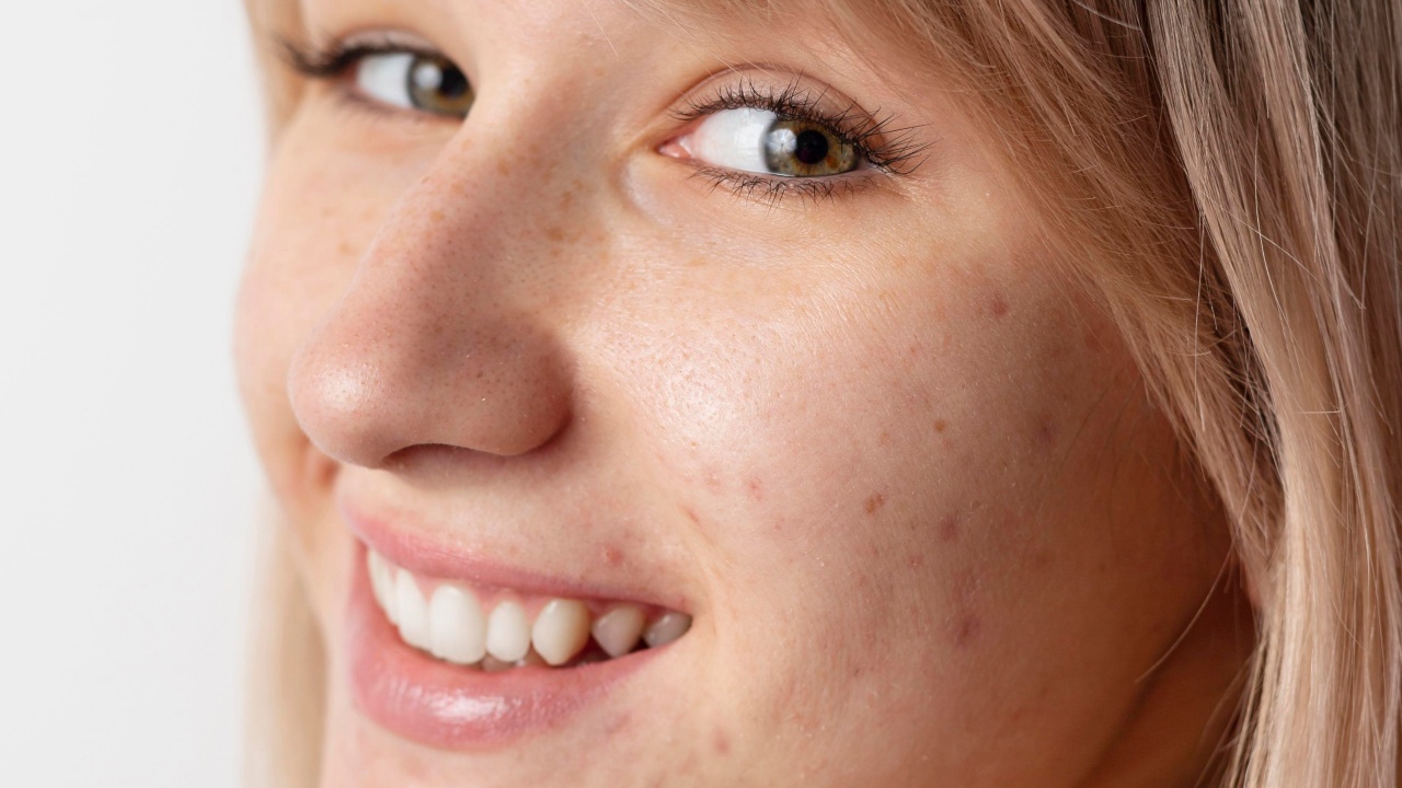 acne adulta