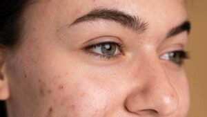 acne adulta